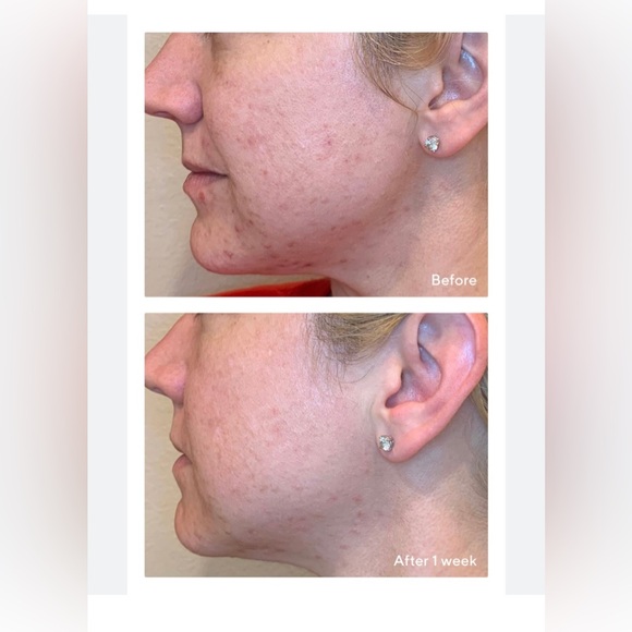 Murad Replenishing Multi-Acid Peel - Picture 6 of 12
